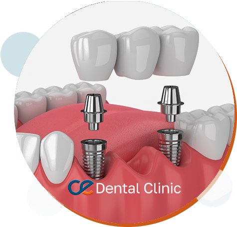 Dental Implant in Turkey