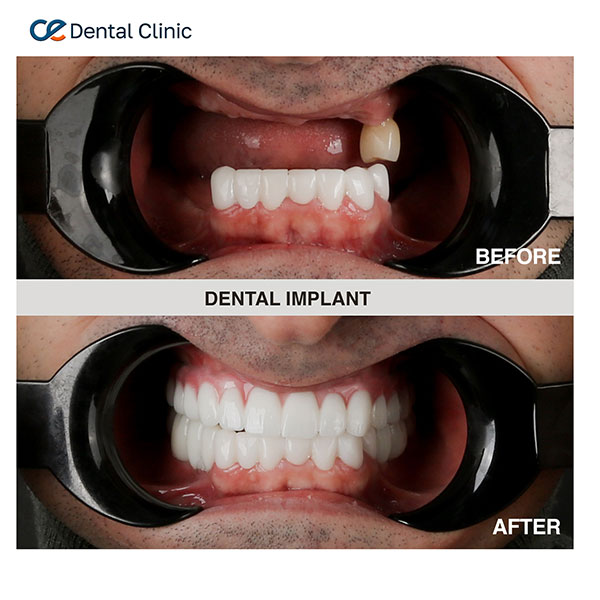 Dental implants Dental implants