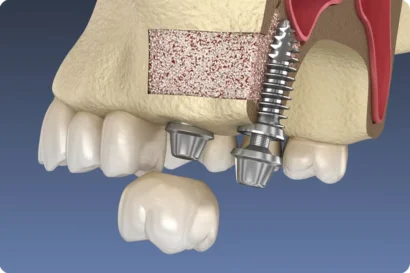 Sinus Lift Turkey